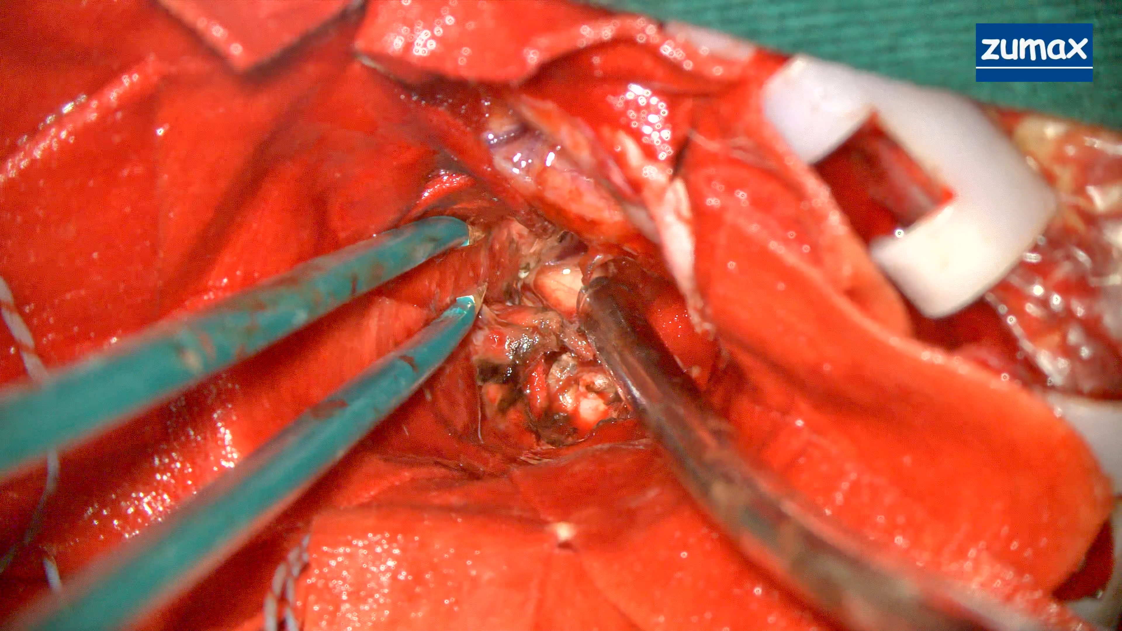 ZUMAX CLINICAL CASE | Left Frontal Craniotomy for Resection of Giant Mass