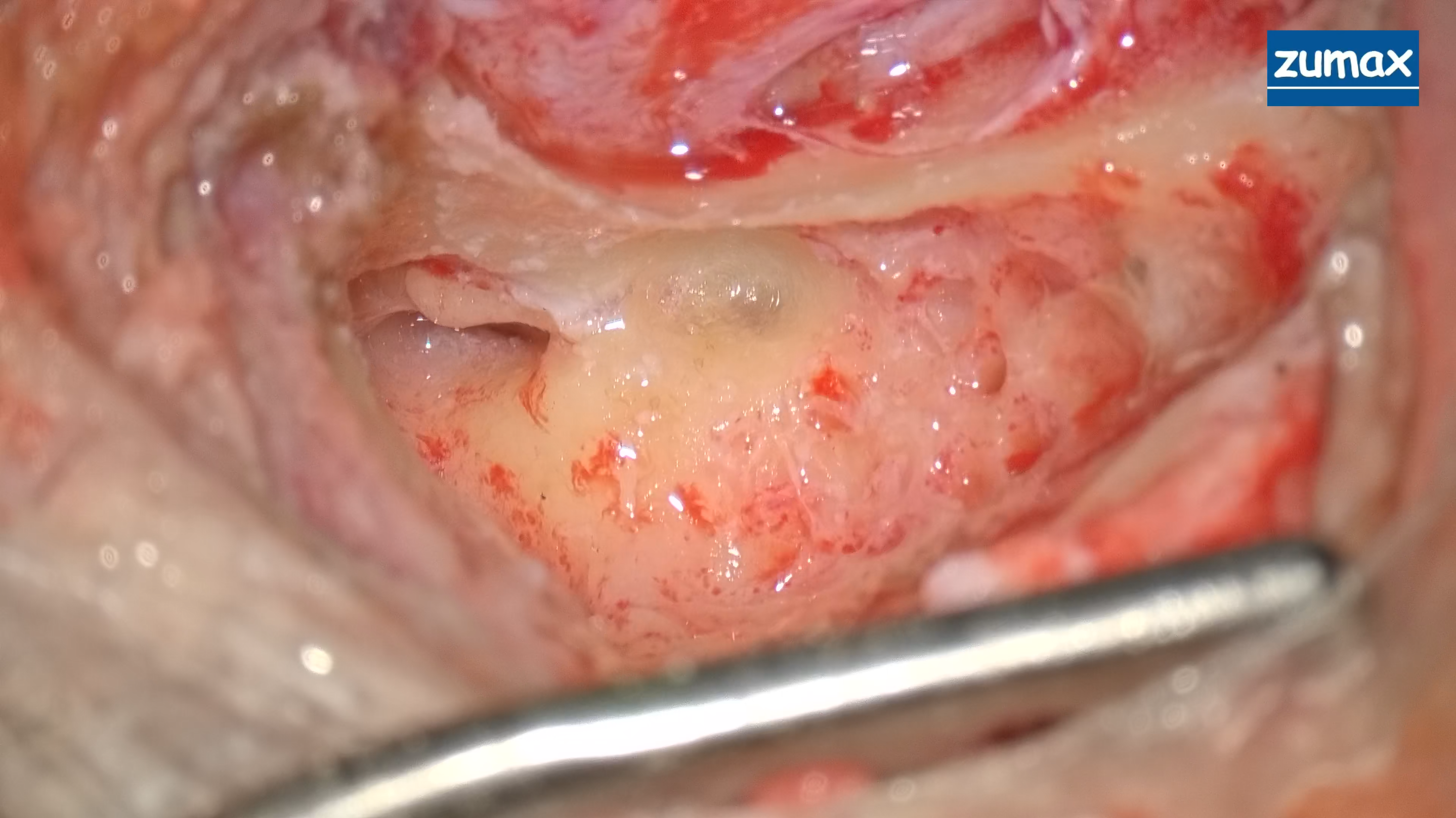 Clinical Case | Cochlear Implant Surgery