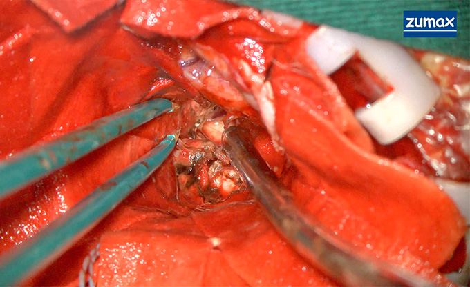 ZUMAX CLINICAL CASE | Left Frontal Craniotomy for Resection of Giant Mass