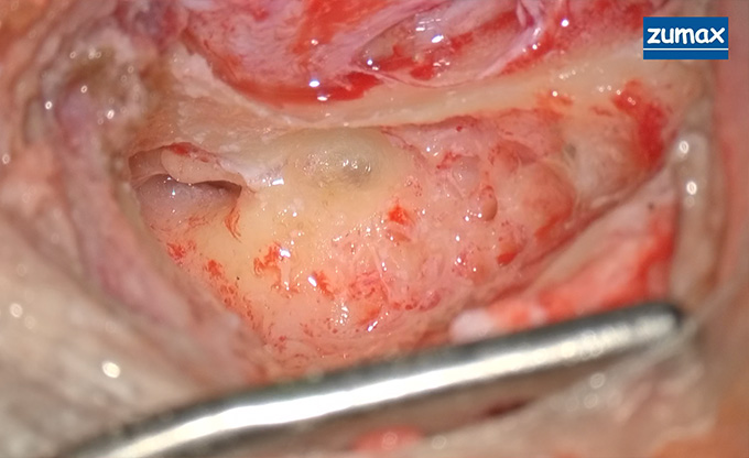 Clinical Case | Cochlear Implant Surgery